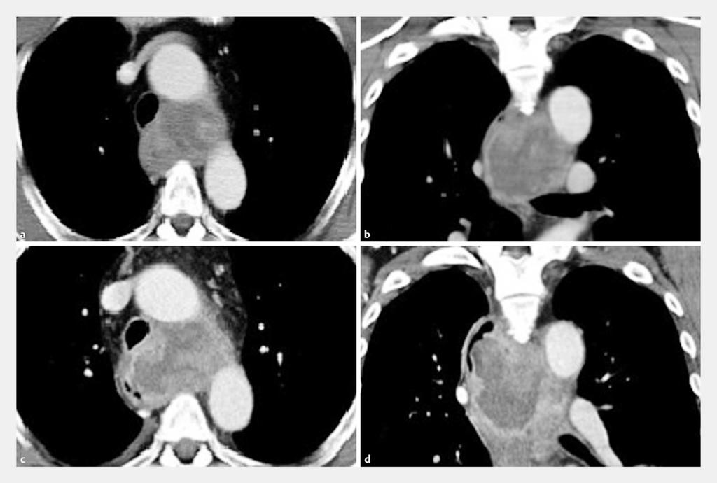 Fig.1 Computed tomography (CT) scan findings. a, b CTscan revealed a 6-cm mediastinal mass.