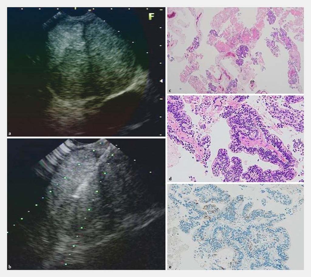 Fig.2 Endoscopic ultrasound findings and pathologic findings of biopsy specimens. a Endoscopic ultrasound showed a tumor with a heterogeneous appearance and a septum.