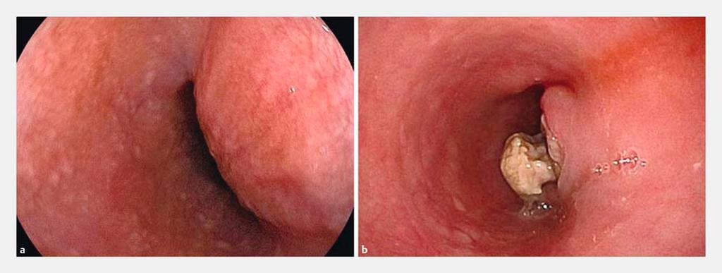Fig.3 Endoscopic findings. a Upper gastrointestinal endoscopy showed a mass effect in the middle esophagus.