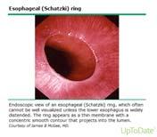Dysphagia Eosinophilic esophagitis Diagnosis S and D