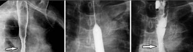 strictures: 1 3 dilations to relieve their symptoms, although 25 35% of patients require