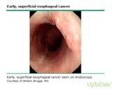 Esophageal Cancer Endoscopy for diagnosis Biopsies (squamous vs adenocarcinoma) Location of tumor Assess