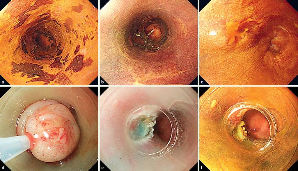 THIEME E843 Fig. 1 Salvage endoscopic mucosal resection using a cap (EMR-C) for locoregional recurrence after chemoradiotherapy.