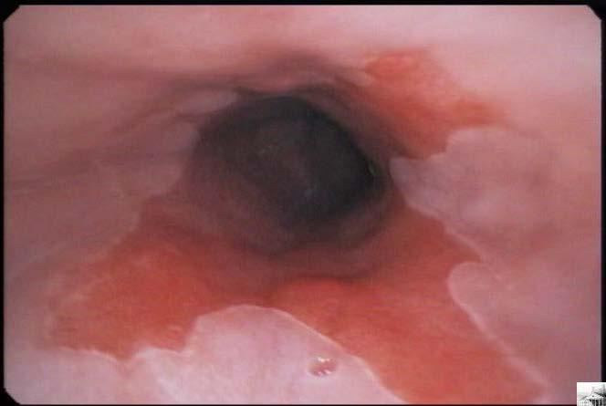Barrett s Esophagus Consequence of chronic GERD Mean age of dx: