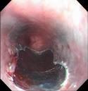 Endoscopic Mucosal Resection Allows