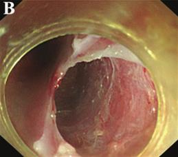 (b) After mucosal injection, a submucosal tunnel (about 5 cm long) was created by ESD technique.