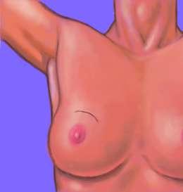 Breast Conserving Surgery?