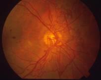 How does diabetic retinopathy cause vision loss? Blood vessels damaged from diabetic retinopathy can cause vision loss in 3 ways Vitreous Hemorrhage.