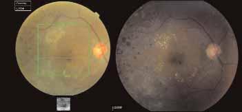 C D Figure 2. Color fundus photographs of an eye with proliferative diabetic retinopathy and diabetic macular edema.