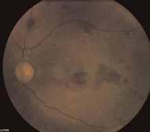 Color fundus photographs of the same eye following vitrectomy and removal of the posterior hyaloid.