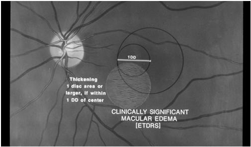 Diabetic Retinopathy Update 2017 Basis for DR management standards for past 40 years Diabetic Retinopathy Study (DRS) 1971-1989 and Early Treatment of Diabetic Retinopathy Study (ETDRS) 1979-1990