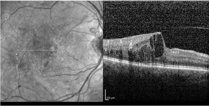 Summary: When to use anti-vegf Anti-VEGF therapy for Diffuse DME/DR: largest chance of vision improvement Prevents worsening DR and actually improves grade of retinopathy and reverses ischemia while