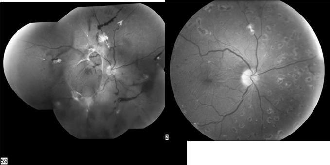 Avastin (1 day prior) followed with vitrectomy/prp Summary Management of diabetic retinopathy as it develops Careful