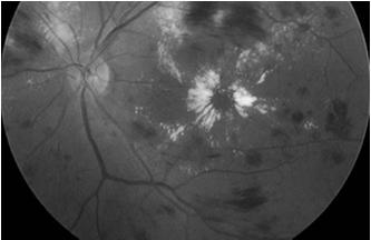 threshold to use Better laser technology now Pharmacologic therapy did not exist Macular Edema Current Pharmacologic options FDA Approved therapy Ranibizumab (Lucentis 0.