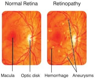 Published on: 12 Apr 2013 Diabetic Retinopathy Diabetic Retinopathy (DR) The most common eye disease among people with diabetes High blood sugar levels and high blood pressure (BP) can damage the