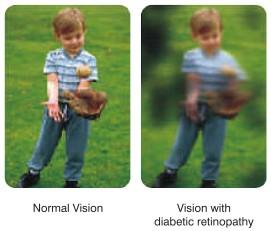 Early signs of diabetic retinopathy can be