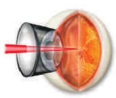 Diabetic retinopathy treatment has a high success rate Laser