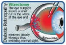 successful at preventing further vision loss Undergoing Vitrectomy