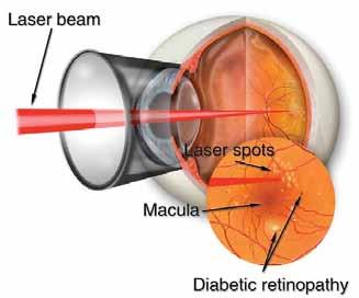 Treatment: Non-proliferative Diabetic Retinopathy 1. Laser Treatment: Non-proliferative diabetic retinopathy is treated with laser when there is swelling of the macula.