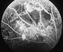 Fig. 3 Vitreous hemorrhage in proliferative diabetic retinopathy Preretinal hemorrhage spread the upper half of the fundus. pathy, and often progresses to proliferative diabetic retinopathy.