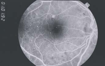 careful observation and treatment of macular edema if it is present. B) Moderate background retinopathy Moderate diabetic retinopathy is a more advanced stage of background retinopathy.