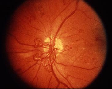 Proliferative diabetic retinopathy (PDR) Later stage of diabetic retinopathy