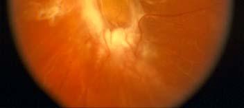 which can lead to (tractional) retinal detachment.