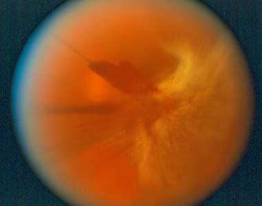 Proliferative diabetic retinopathy With PDR, vision is affected when any of the following occur: Vitreous hemorrhage (new abnormal blood vessels bleed into the vitreous gel, preventing light rays