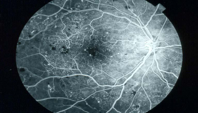 What happens during an eye exam Fluorescein angiography helps the ophthalmologist determine: Why vision is blurred.