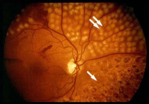 Treating diabetic retinopathy Laser surgery for PDR (Proliferative Diabetic Retinopathy) Laser is focused on all parts of the retina except the macula.