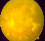 Non Proliferative Diabetic Retinopathy (NPDR) In nonproliferative diabetic retinopathy (also called background retinopathy), the retina may contain capillary leakage, capillary closure, or a