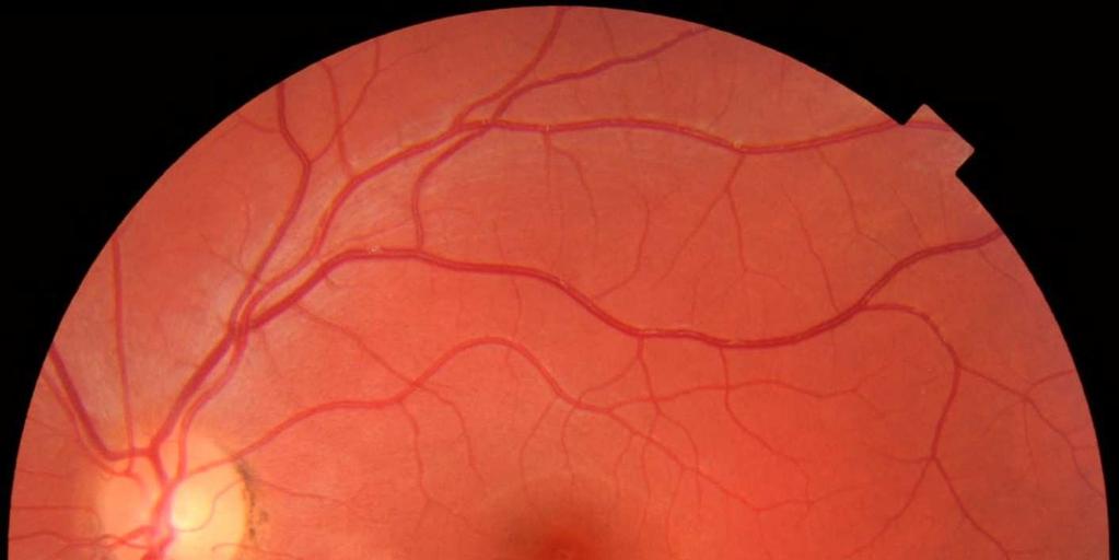 Clinically significant macular oedema (CSMO) X Macula centre Thickening/o edema