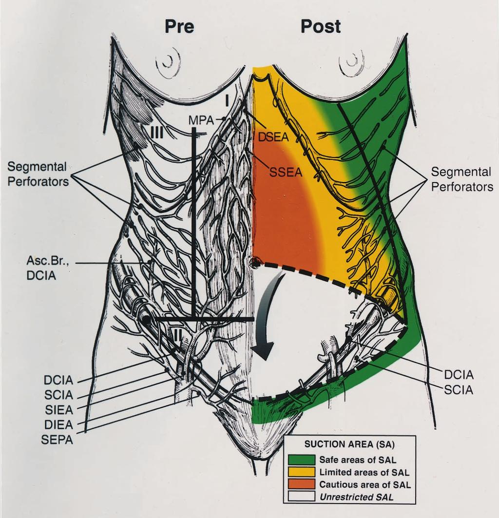 1198 PLASTIC AND RECONSTRUCTIVE SURGERY, October 2000 FIG. 2.(Left) Pre(operative): the blood supply to the anterior abdominal wall. Note Huger zones I through III.