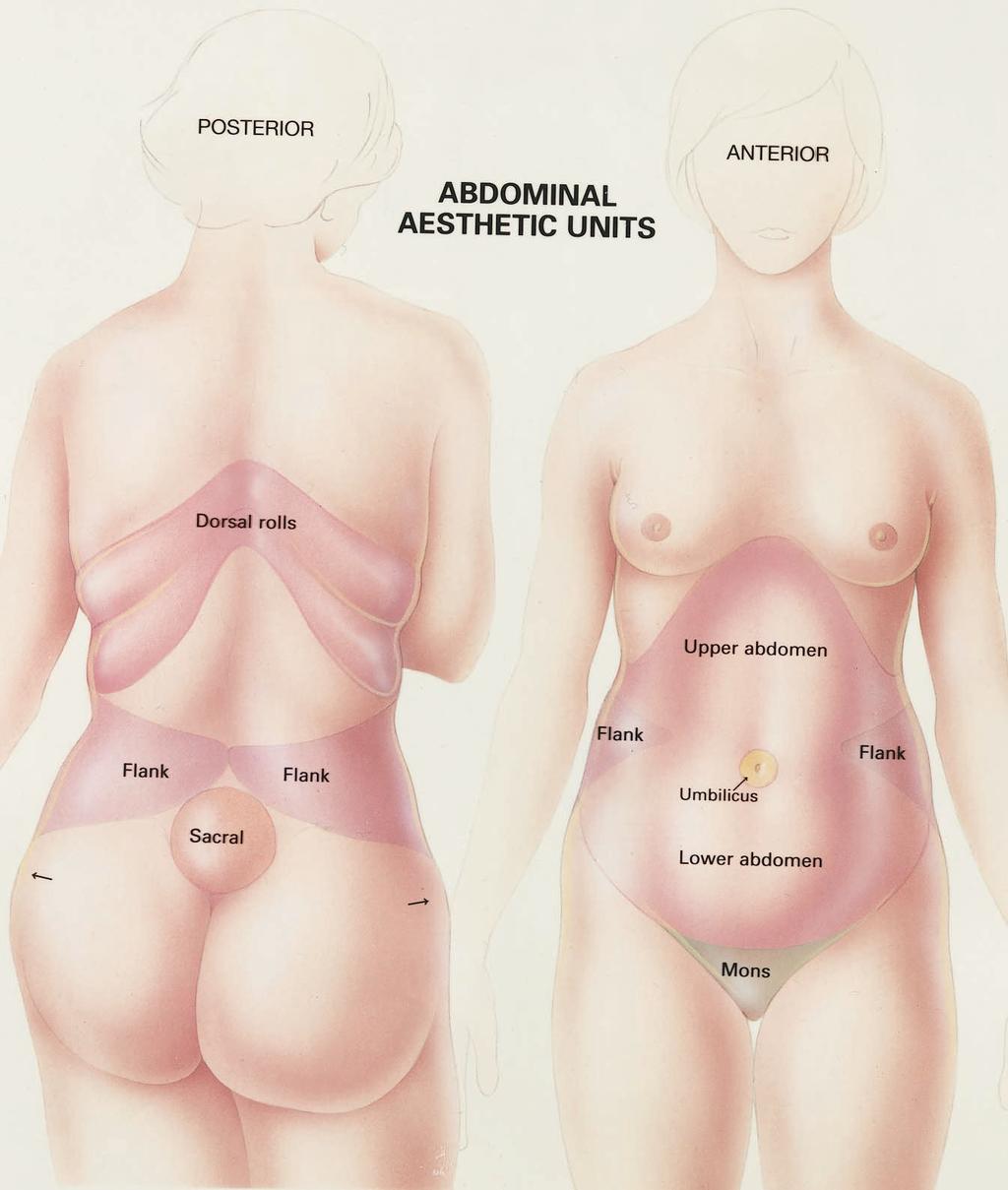 1200 PLASTIC AND RECONSTRUCTIVE SURGERY, October 2000 are many abdominal contour operations available, they are not interchangeable; liposuction, limited abdominoplasty, and full abdominoplasty, with