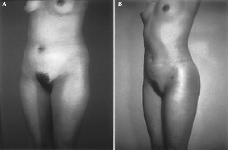 448 Body Contour Improvement Fig. 2. A 23-year-old woman underwent body contour improvement solely through liposuction. The patientõs skin is excellent.