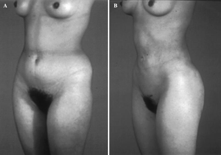 L. Cárdenas-Camarena 449 Fig. 3. A 22-year-old women treated exclusively with liposuction achieved an adequate contour with an acceptable cutaneous retraction.