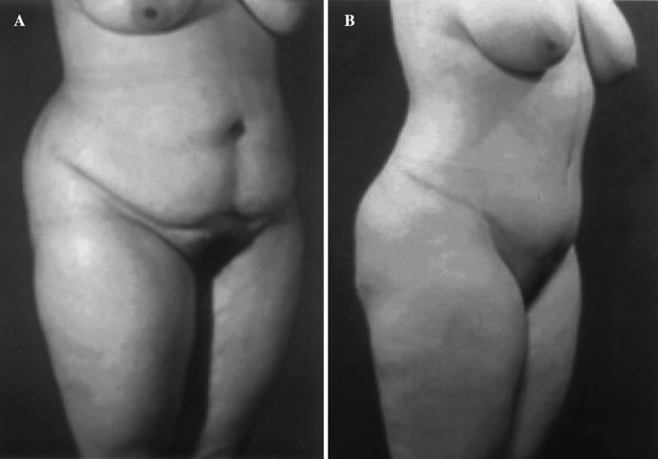 450 Body Contour Improvement Fig. 4. A 39-year-old woman presented with adequate skin quality and severe abdominal flaccidity.