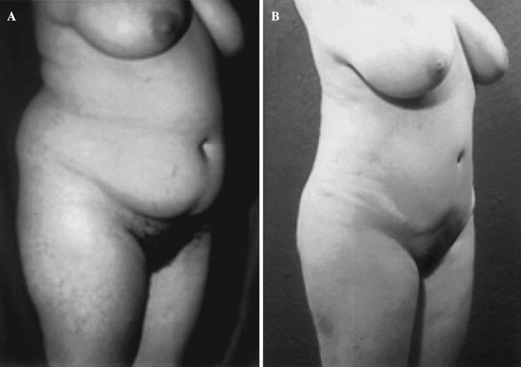 A 35-year-old woman with regular skin quality achieved an excellent contour at the thoracoabdominal level when treated with a combination of liposuction and abdominoplasty.