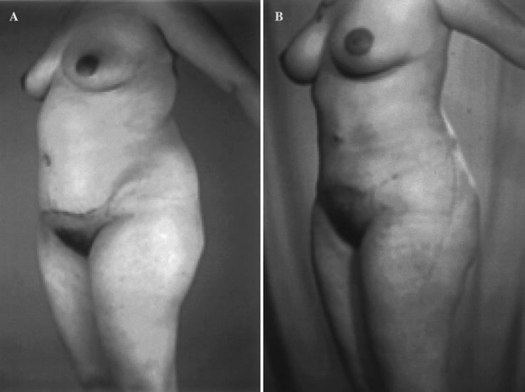 L. Cárdenas-Camarena 451 Fig. 6. A 24-year-old woman previously underwent an abdominoplasty.