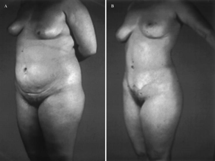A 39-year-old woman presented with thoracoabdominal lipodystrophy and mammary ptosis.