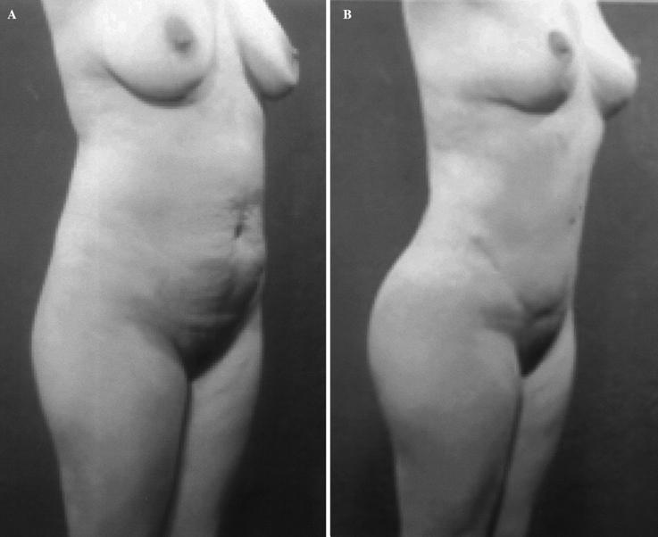 452 Body Contour Improvement Fig. 8. A 31-year-old woman presented with moderate body lipodystrophy as well as mammary ptosis and abdominal flaccidity.