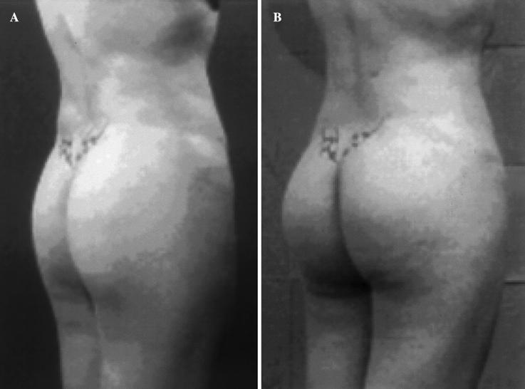 liposuction and fat infiltration in the gluteal region and achieved an excellent result. Fig. 10.