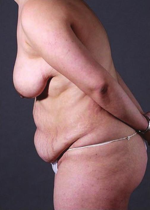 S80 Aesthetic Surgery Journal 38(S2) A B Figure 7. A 38-year-old, gravida 3 woman, with significant abdominal wall and skin laxity and refused abdominoplasty.