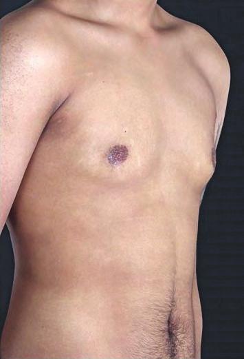 S82 Aesthetic Surgery Journal 38(S2) A B Figure 9. A 28-year-old man with gynecomastia treated with radiofrequency-assisted liposuction (RFAL).