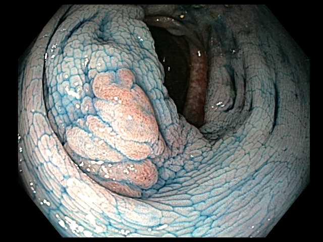 68-year-old with pan UC x 18 years for surveillance colonoscopy White light, high definition White light, high definition, indigo carmine Where do the guidelines stand?
