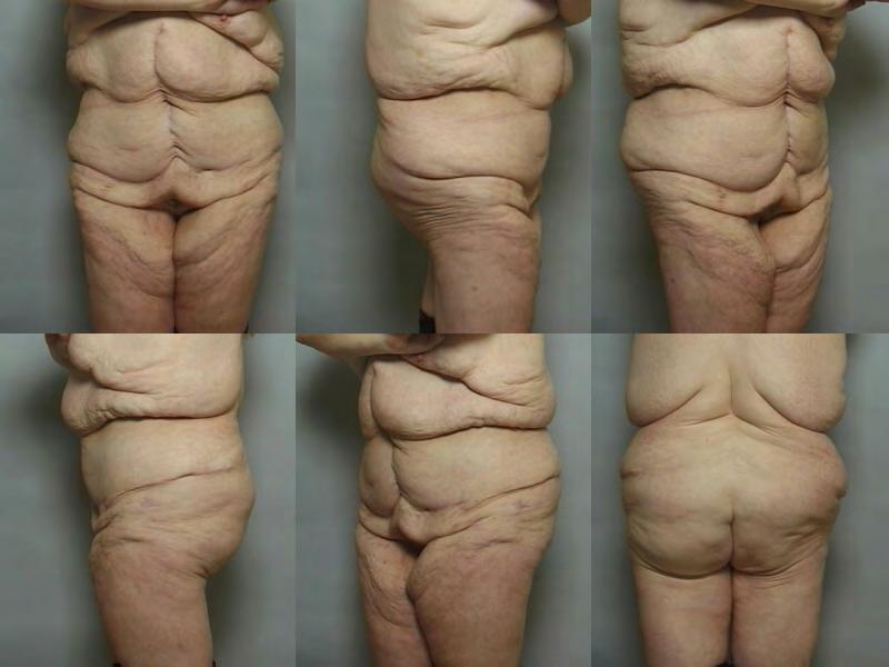 T Shaped Panniculectomy Even when done