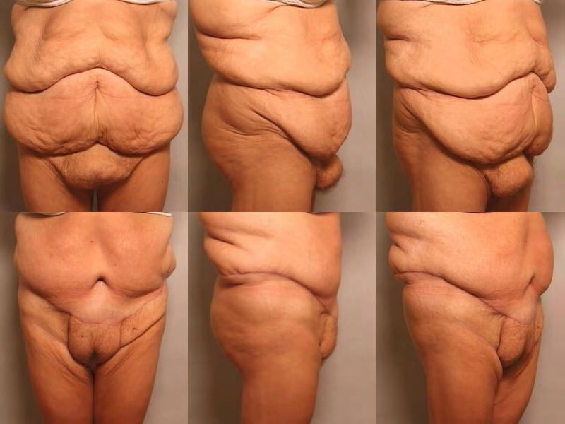 Tummy Tuck only in a massive
