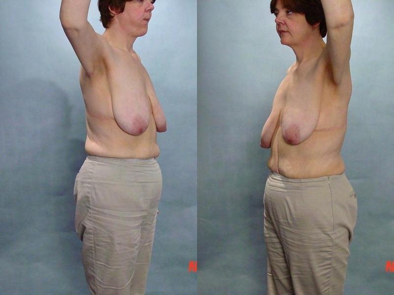 PostOp: False Age: 40 The Posterior Axillary fold Presentation If greatly deflated ideal If significantly