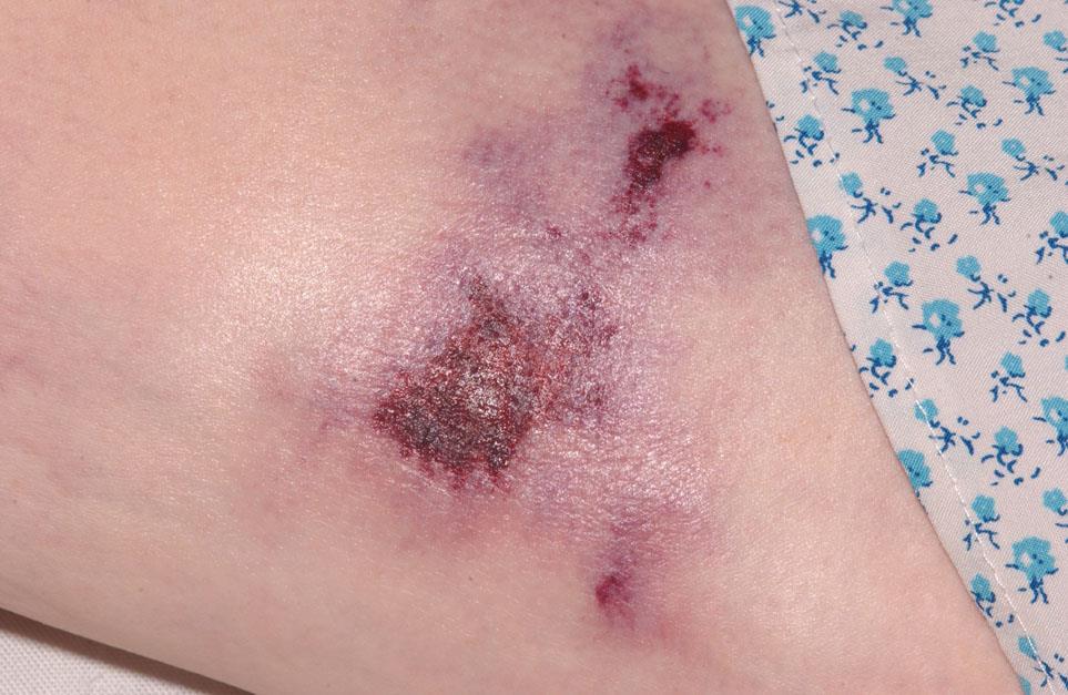 non-healing ulcers