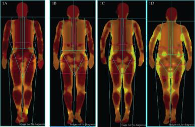 Measuring Muscle and Fat with DXA Individuals with the same body mass index can have